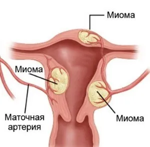 Інтерстиціально-субсерозна міома матки симптоми і лікування (інтерстиціальна міома матки) Інтерстиціально-субсерозна міома матки симптоми і лікування