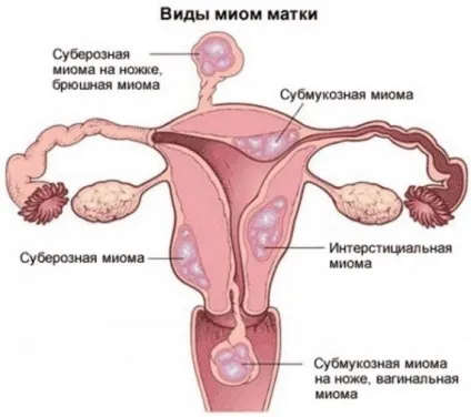 Інтерстиційна міома матки симптоми і особливості лікування