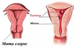 Як лікувати поліпи матки народні способи