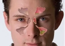 Як визначити і розпізнати гайморит, все про лікування нежиті і гаймориту! (Нежиті) Як визначити і розпізнати гайморит, все про лікування нежиті і гаймориту!