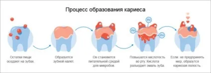 Як зупинити карієс - методи лікування і профілактики (карієс) Як зупинити карієс - методи лікування і профілактики