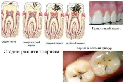 Як зупинити карієс - методи лікування і профілактики (зупинити) Як зупинити карієс - методи лікування і профілактики