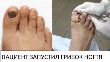 Як повністю позбавитися від грибкової інфекції нігтів і стоп (повністю) Як повністю позбавитися від грибкової інфекції нігтів і стоп