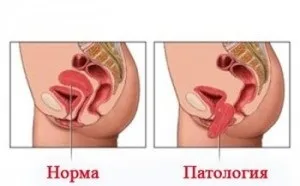 Як поставити внутрішні органи на місце, на шляху до довголіття (поставити) Як поставити внутрішні органи на місце, на шляху до довголіття