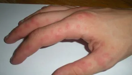 Як проявляється алергія - у дітей і дорослих на продукти, на кішок і собак, відео (симптоми) Як проявляється алергія - у дітей і дорослих на продукти, на кішок і собак, відео