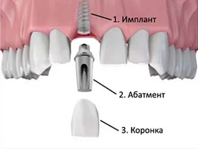 Як відновити зуб, якщо його немає (Самий економний варіант) Як відновити зуб, якщо його немає