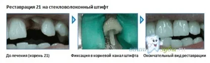 Як відновити зуб, якщо його немає (Самий економний варіант) Як відновити зуб, якщо його немає