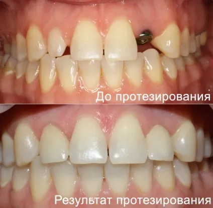 Як відновити зуб, якщо його немає (відновити) Як відновити зуб, якщо його немає