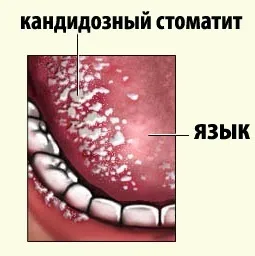 Кандидозний стоматит у дітей види, лікування та профілактика (кандидозний) Кандидозний стоматит у дітей види, лікування та профілактика
