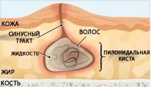Кіста куприка причини виникнення, симптоми і лікування (симптоми) Кіста куприка причини виникнення, симптоми і лікування