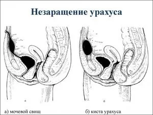Кіста урахуса опис, причини, симптоми і методи лікування (симптоми) Кіста урахуса опис, причини, симптоми і методи лікування