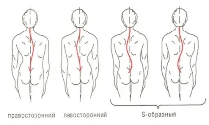 Клиновидна деформація тіл хребців грудного відділу причини, симптоми, лікування (грудного) Клиновидна деформація тіл хребців грудного відділу причини, симптоми, лікування