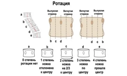 Клиновидна деформація тіл хребців грудного відділу причини, симптоми, лікування (деформація) Клиновидна деформація тіл хребців грудного відділу причини, симптоми, лікування