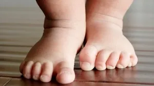 Клишоногість у дітей придбана і вроджена клишоногість, лікування клишоногості, гіпсування при