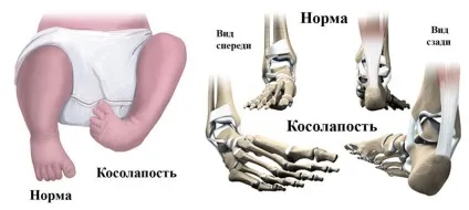 Клишоногість у дітей придбана і вроджена клишоногість, лікування клишоногості, гіпсування при
