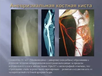 Кісткова кіста причини, лікування у дорослих і дітей (кіста) Кісткова кіста причини, лікування у дорослих і дітей