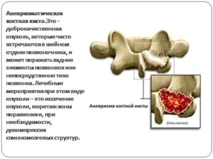 Кісткова кіста причини, лікування у дорослих і дітей (кісткова) Кісткова кіста причини, лікування у дорослих і дітей