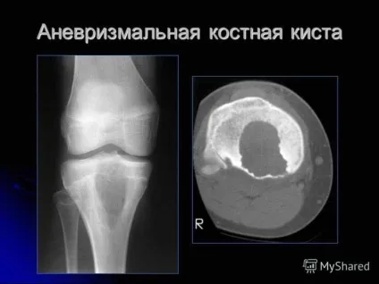 Кісткова кіста причини, лікування у дорослих і дітей (кіста) Кісткова кіста причини, лікування у дорослих і дітей