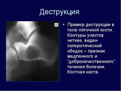 Кісткова кіста причини, лікування у дорослих і дітей (лікування) Кісткова кіста причини, лікування у дорослих і дітей