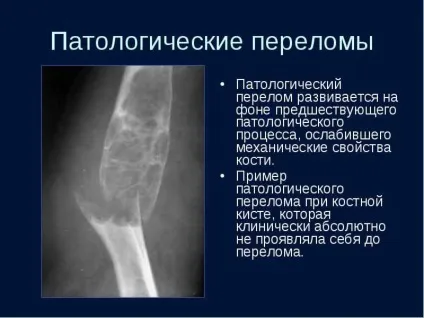Кісткова кіста причини, лікування у дорослих і дітей (лікування) Кісткова кіста причини, лікування у дорослих і дітей