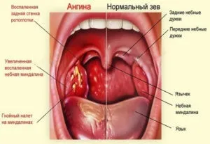 Лакунарна ангіна у дітей як лікувати (ангіна) Лакунарна ангіна у дітей як лікувати