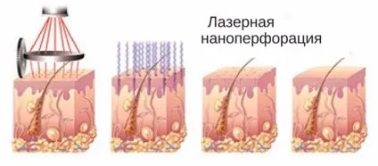 Лазерна наноперфорація як допоможе повернути привабливість особі, шкірі, від розтяжок, століть, догляд (шкірі) Лазерна наноперфорація як допоможе повернути привабливість особі, шкірі, від розтяжок, століть, догляд
