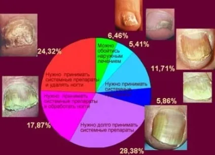 Лак для нігтів від грибка на руках і ногах огляд (грибка) Лак для нігтів від грибка на руках і ногах огляд