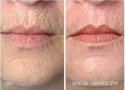 Лазерна наноперфорація як допоможе повернути привабливість особі, шкірі, від розтяжок, століть, догляд (лазерна) Лазерна наноперфорація як допоможе повернути привабливість особі, шкірі, від розтяжок, століть, догляд