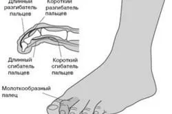 Лікування молоткообразной деформації пальців стопи (молоткообразной) Лікування молоткообразной деформації пальців стопи