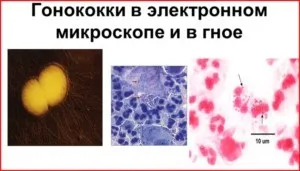Лікування гнійного кон'юнктивіту очей у дітей та дорослих (фото) (гнійного) Лікування гнійного кон'юнктивіту очей у дітей та дорослих (фото)