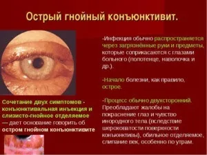 Лікування гнійного кон'юнктивіту очей у дітей та дорослих (фото) (очей) Лікування гнійного кон'юнктивіту очей у дітей та дорослих (фото)