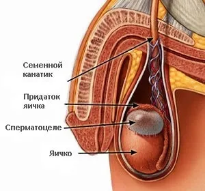 лікування сперматоцеле