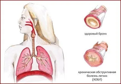 Лікування бронхіту прополісом, блог Галини Лук'янової (лікування) Лікування бронхіту прополісом, блог Галини Лук'янової