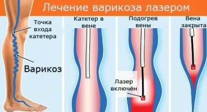 Лікування варикозу в москві клініки, ціни, відгуки, підбір флеболога онлайн (москві) Лікування варикозу в москві клініки, ціни, відгуки, підбір флеболога онлайн