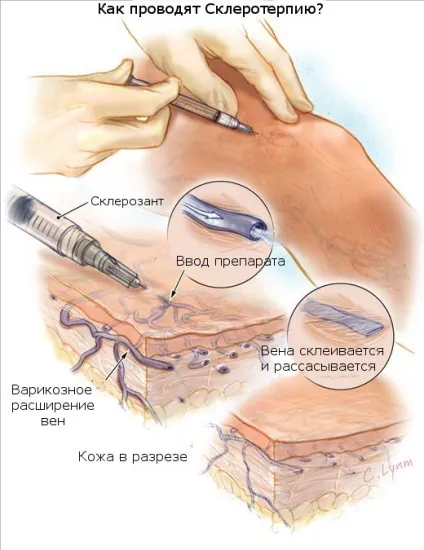 Лікування варикозу в москві клініки, ціни, відгуки, підбір флеболога онлайн (москві) Лікування варикозу в москві клініки, ціни, відгуки, підбір флеболога онлайн