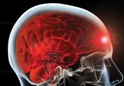 Лопнула судина в головному мозку, відповіді лікарів, консультація (головному) Лопнула судина в головному мозку, відповіді лікарів, консультація