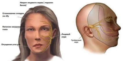 Лицевий нерв - що це таке, що робити при його запаленні, причини та діагностика хвороби