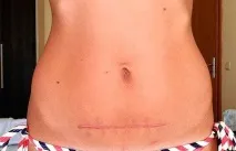 Шрам після кесаревого розтину фото, способи видалення - My Life шрам