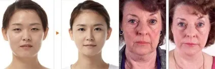 Масаж асахі для обличчя і тіла, фото до і після, відео російською мовою (масаж асахі) Масаж асахі для обличчя і тіла, фото до і після, відео російською мовою