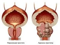 Медикаментозне лікування аденоми простати які призначаються препарати і операції (лікування) Медикаментозне лікування аденоми простати які призначаються препарати і операції