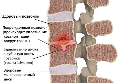 Методика правильного лікування грижі Шморля (Шморля) Методика правильного лікування грижі Шморля