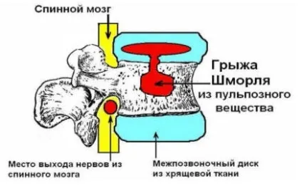 Методика правильного лікування грижі Шморля (більш серйозні проблеми) Методика правильного лікування грижі Шморля