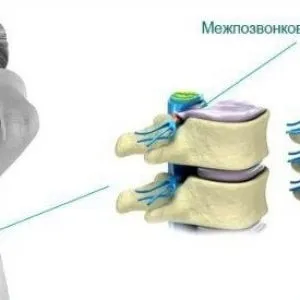 Міжхребцева грижа поперекового відділу лікування, видалення, симптоми міжхребцевої грижі (лікування) Міжхребцева грижа поперекового відділу лікування, видалення, симптоми міжхребцевої грижі