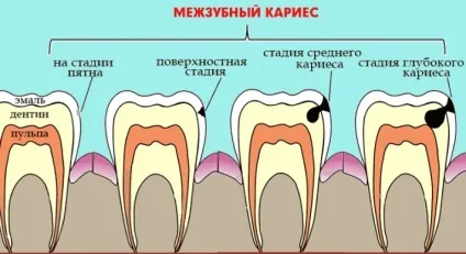 Міжзубної карієс лікування, симптоми, профілактика та причини карієсу між зубами (зубами) Міжзубної карієс лікування, симптоми, профілактика та причини карієсу між зубами