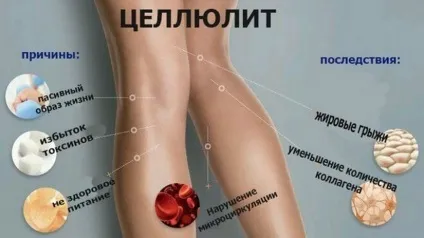 Міфи і факти про целюліт