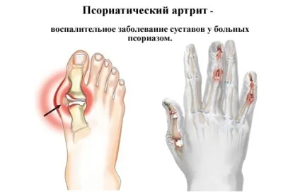 Метотрексат при ревматоїдному артриті лікування і відгуки (метотрексат) Метотрексат при ревматоїдному артриті лікування і відгуки