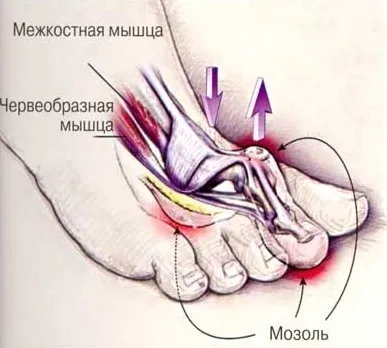Молоткообразная деформація пальців стопи і її причини (деформація) Молоткообразная деформація пальців стопи і її причини
