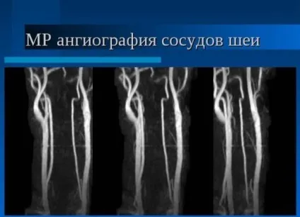 Мрт судин шиї - що показує (показує) Мрт судин шиї - що показує