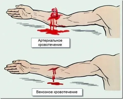 Накладення пов'язки, що давить - студопедія (накладення) Накладення пов'язки, що давить - студопедія