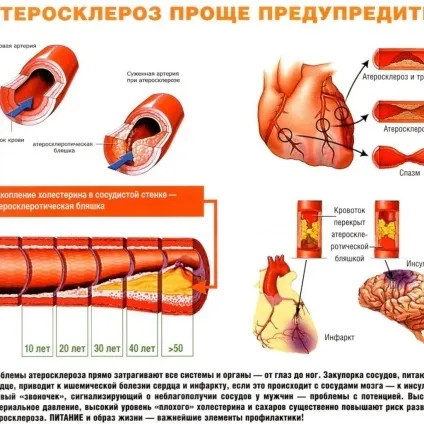Нестабільна стенокардія симптоми і лікування, класифікація та інші особливості (стенокардія) Нестабільна стенокардія симптоми і лікування, класифікація та інші особливості